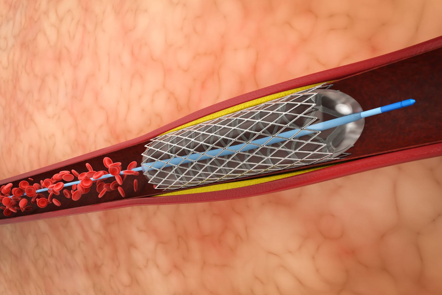 Angioplastia coronaria en Puebla: Procedimiento mínimamente invasivo para recuperar la salud de tu corazón