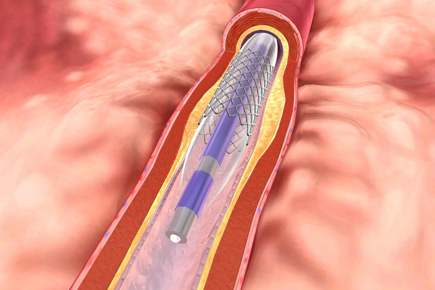 Cateterismo cardiaco